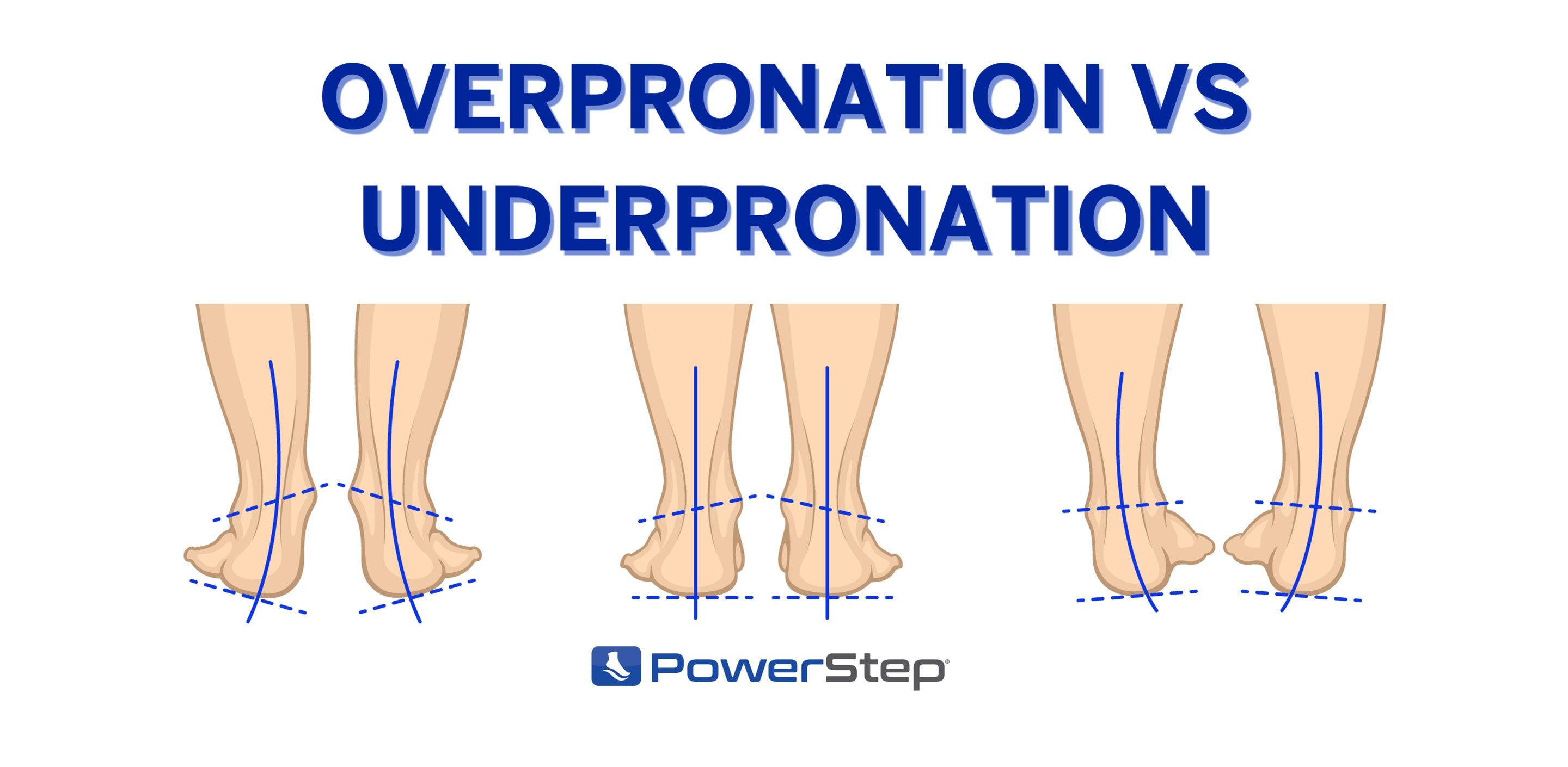 What is Overpronation vs Underpronation? PowerStep
