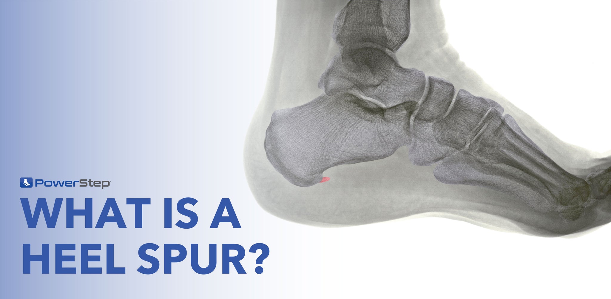 What is a Heel Spur?