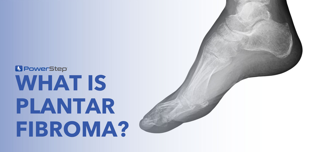 What is Plantar Fibroma?